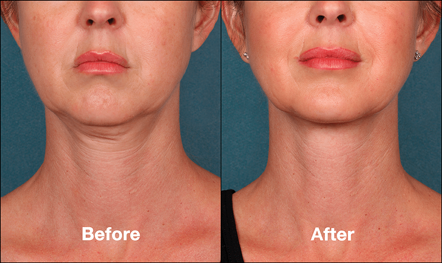 kybella before and after