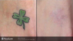 four-leaf clover tattoo before and after picosure tattoo removal, completely invisible after treatment