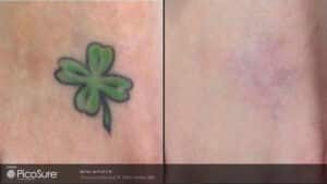 four-leaf clover tattoo before and after picosure tattoo removal, completely invisible after treatment