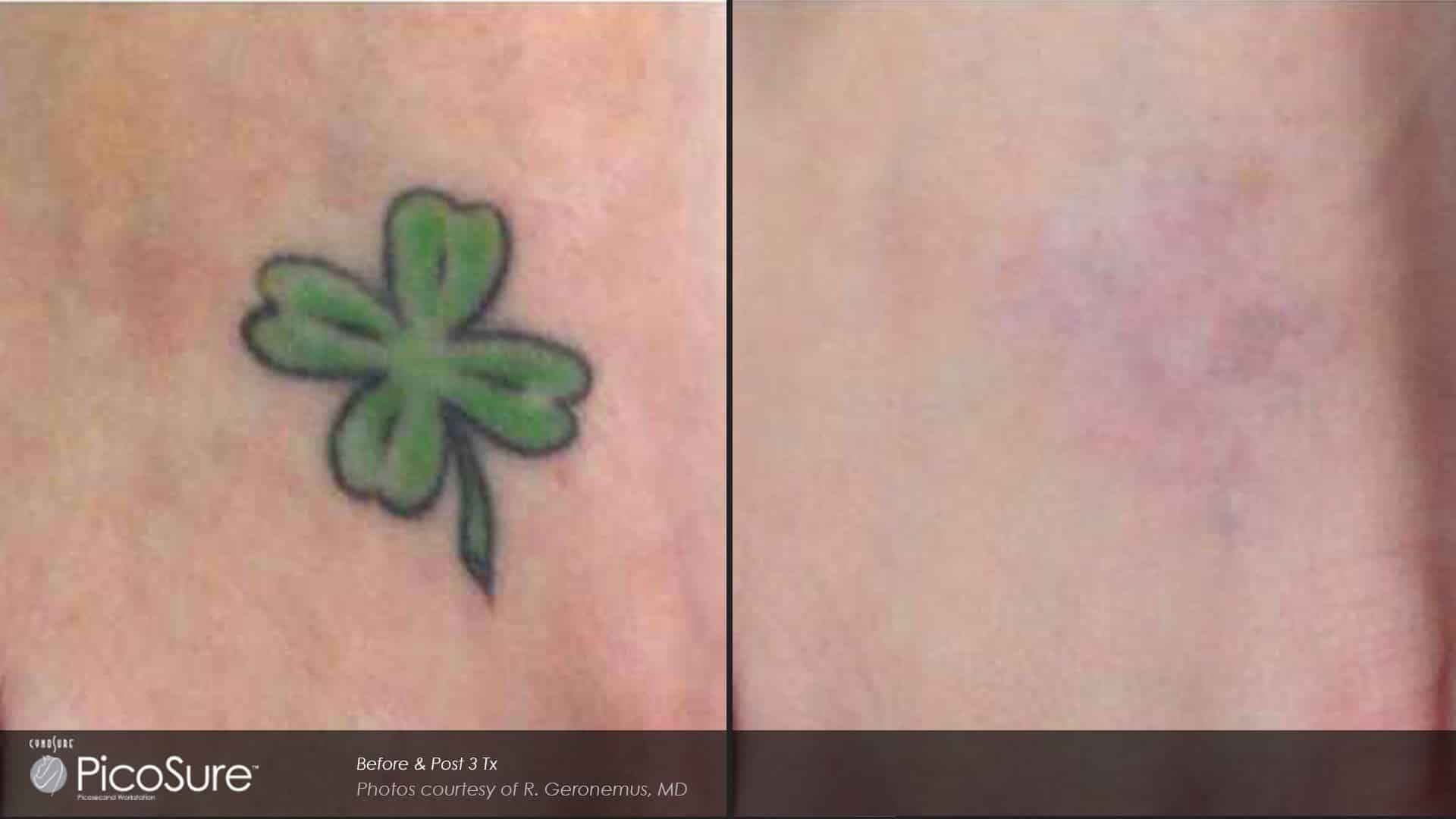 PicosureTattoo4