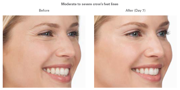 smiling woman before and after botox injections, crow’s feet near eyes gone after procedure