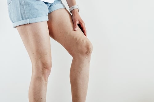 Can Lasers Treat Spider Veins? 64f8e4244ab3a.jpeg