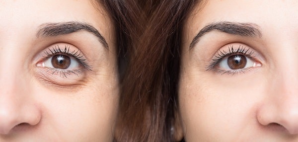 What Can Blepharoplasty Do? 64f8e4307c069.jpeg