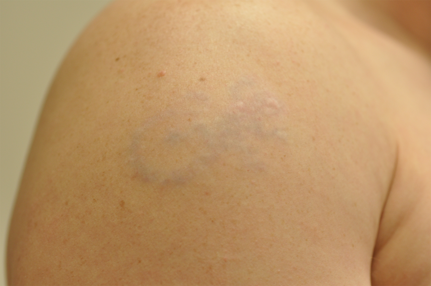 After Image: Laser Tattoo Removal - front
