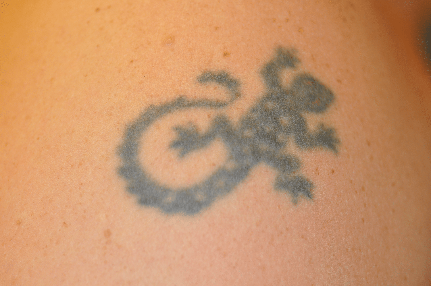 Before Image: Laser Tattoo Removal - front