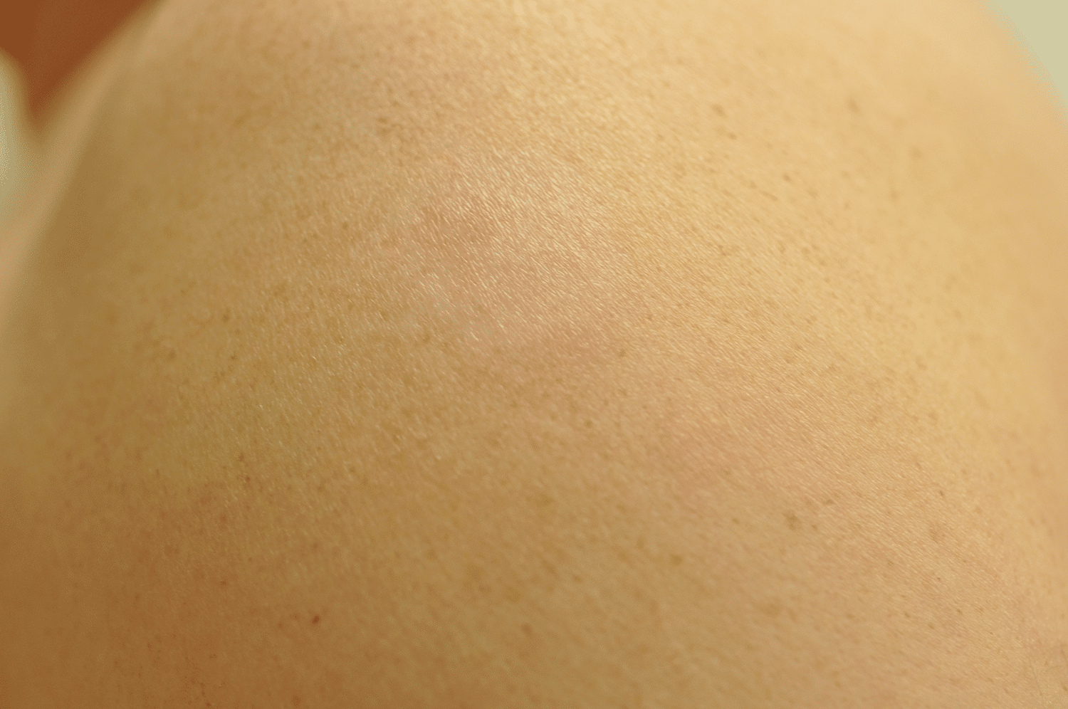 After Image: Laser Tattoo Removal - front