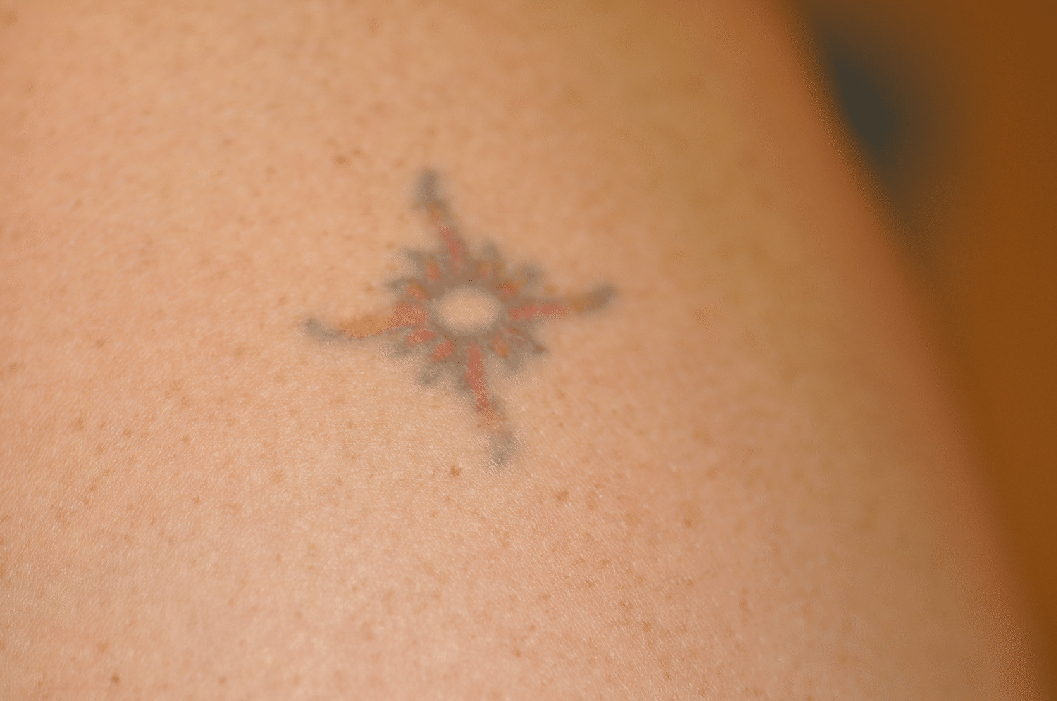 Before Image: Laser Tattoo Removal - front