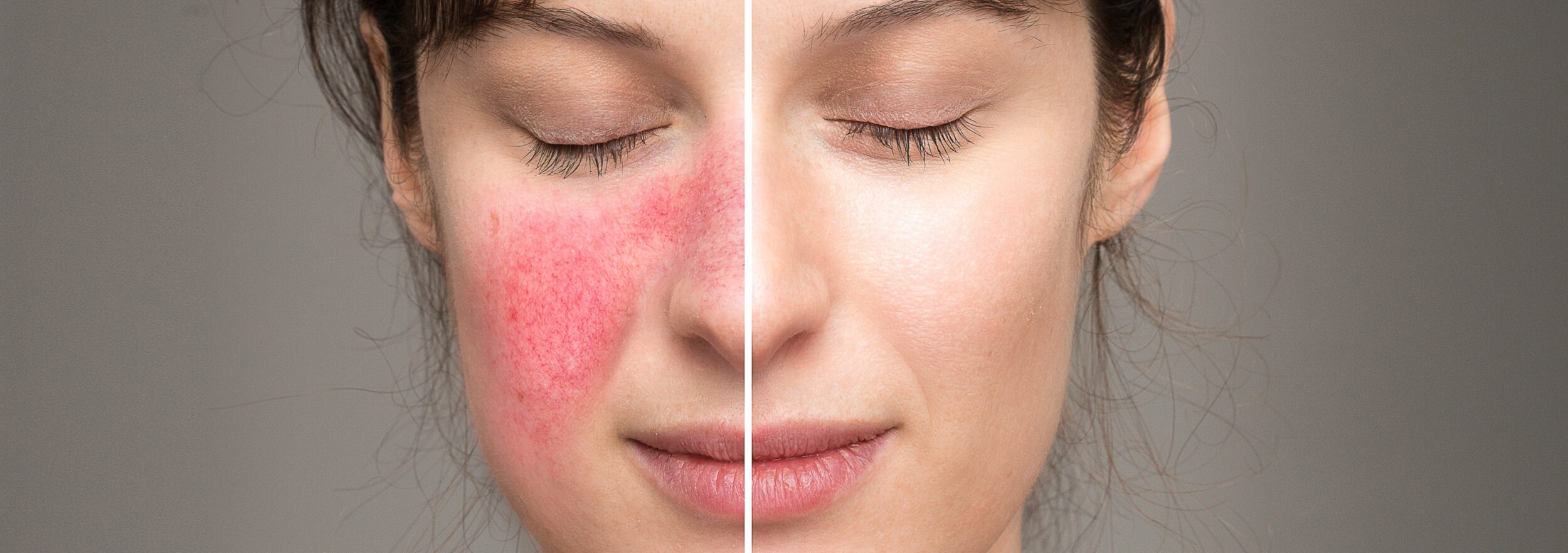 Signs,And,Symptoms,Of,Rosacea:,Natural,Cures,In,The,Treatment