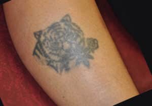 Laser Tattoo Removal