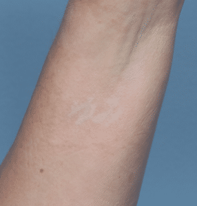 Laser Tattoo Removal