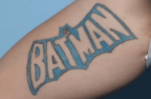 Laser Tattoo Removal