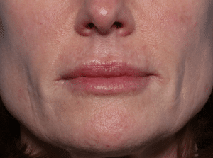 After Image: Filler