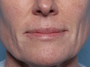 Before Image: Filler