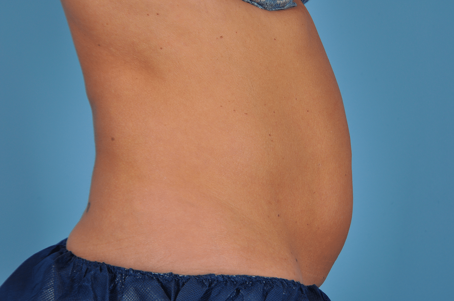 Before Image: CoolSculpting – Abdomen - right-side