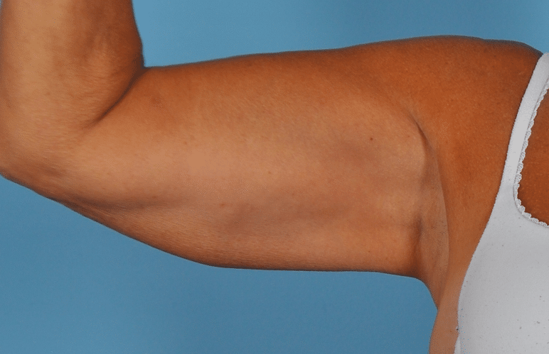 After Image: CoolSculpting – Arms - front
