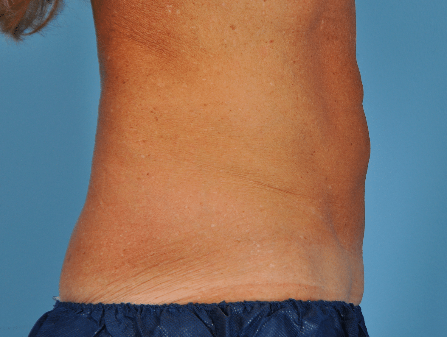 After Image: CoolSculpting – Abdomen - right-side