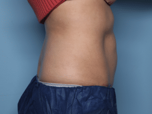 After Image: CoolSculpting – Abdomen