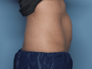 Before Image: CoolSculpting – Abdomen