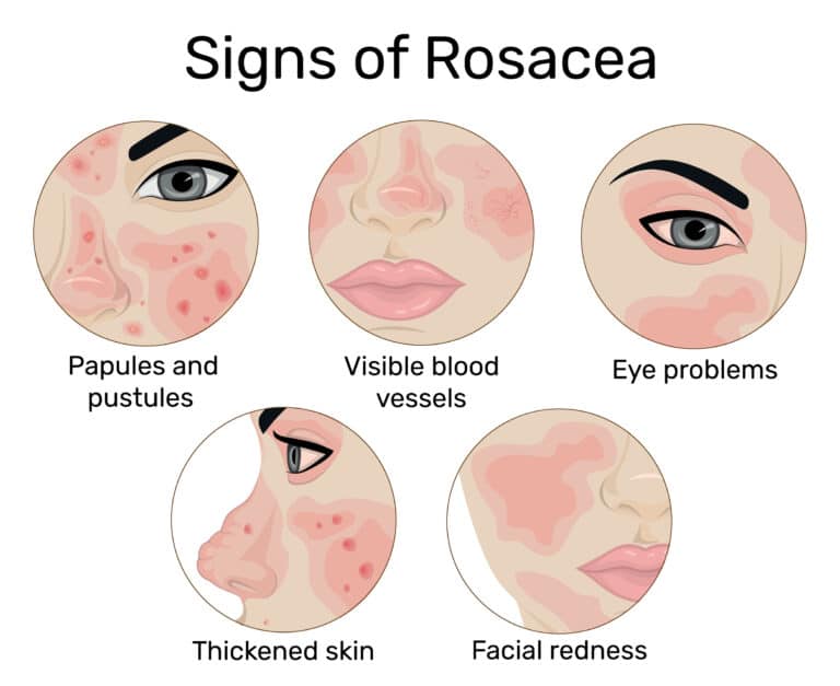 An,Illustration,Of,The,Five,Signs,Of,Rosacea,Such,As
