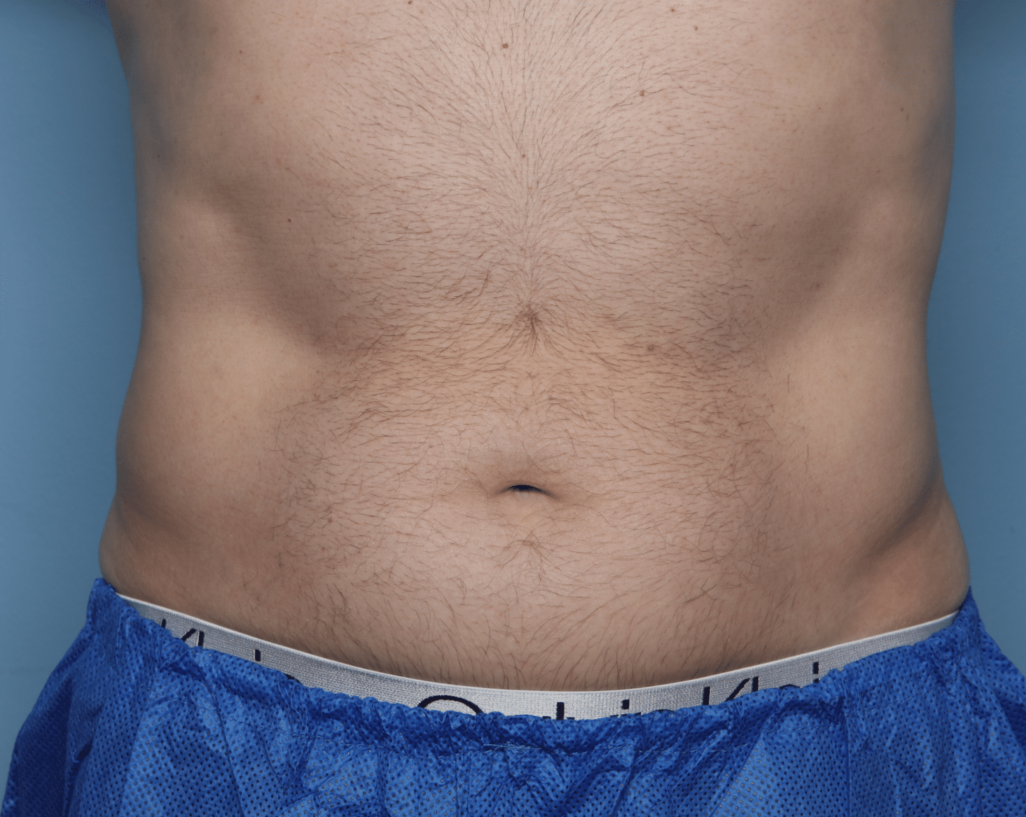 After Image: CoolSculpting – Flanks - front