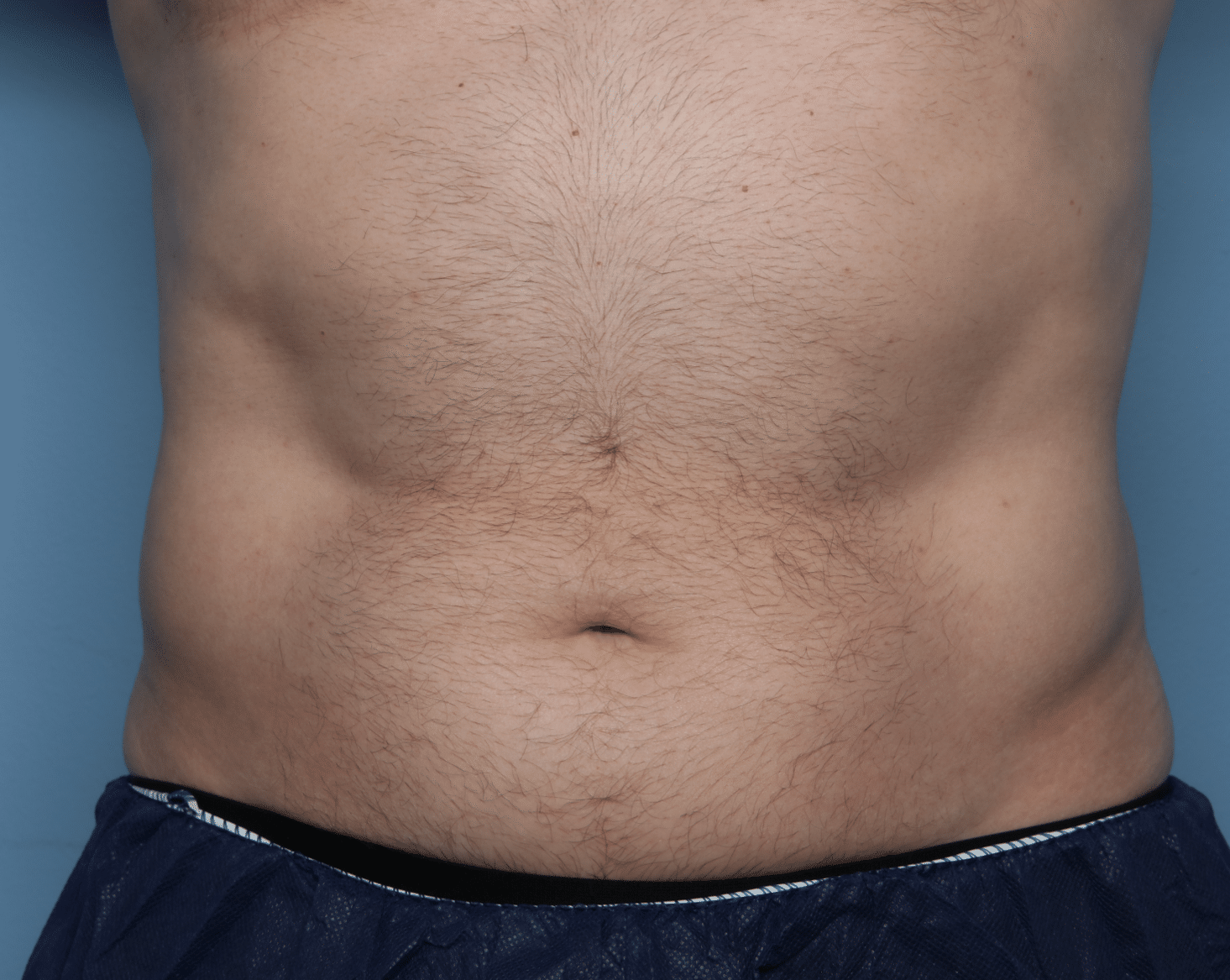 Before Image: CoolSculpting – Flanks - front