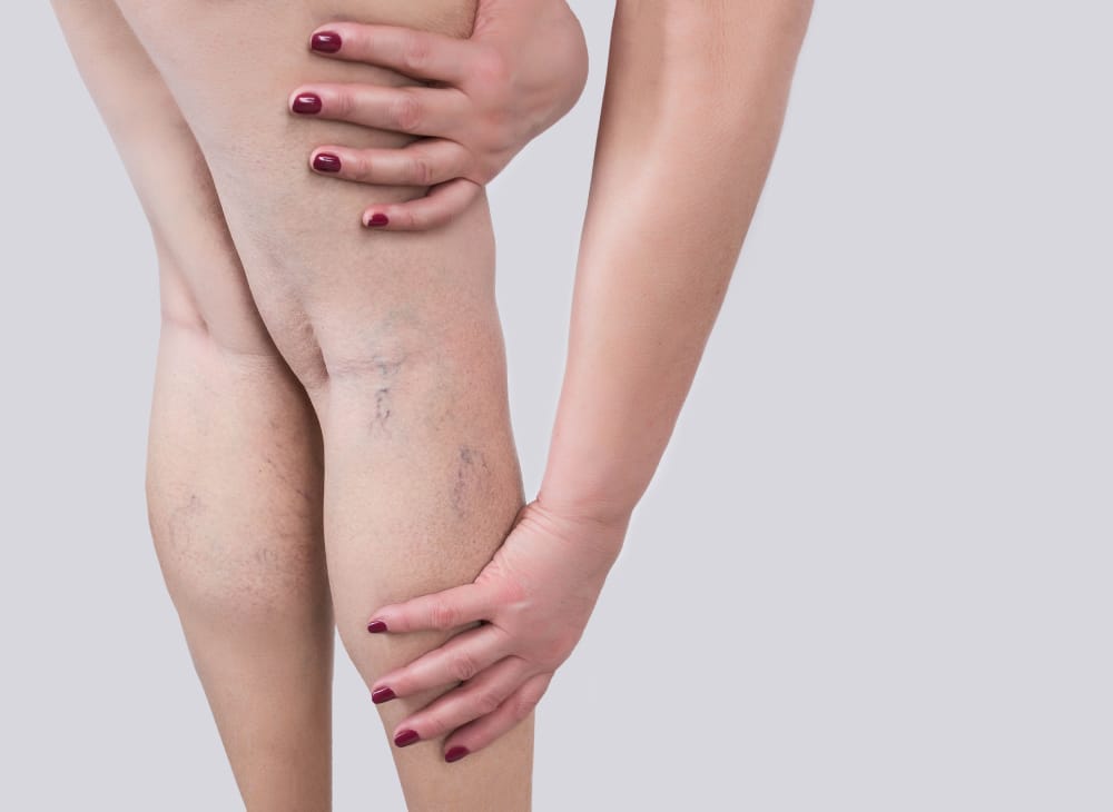 A close-up shot of a woman with spider veins on her legs