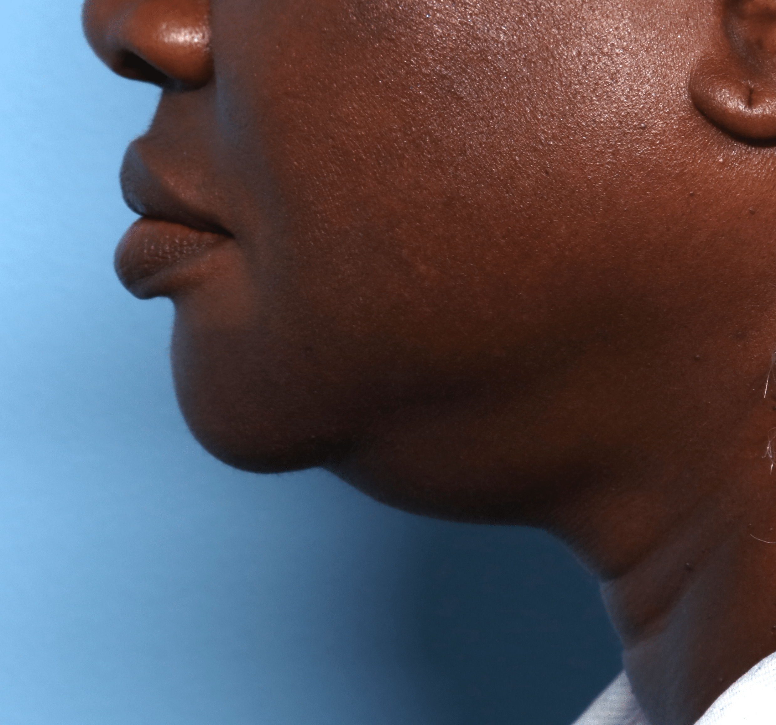 Before Image: CoolSculpting – Submentum - left-side