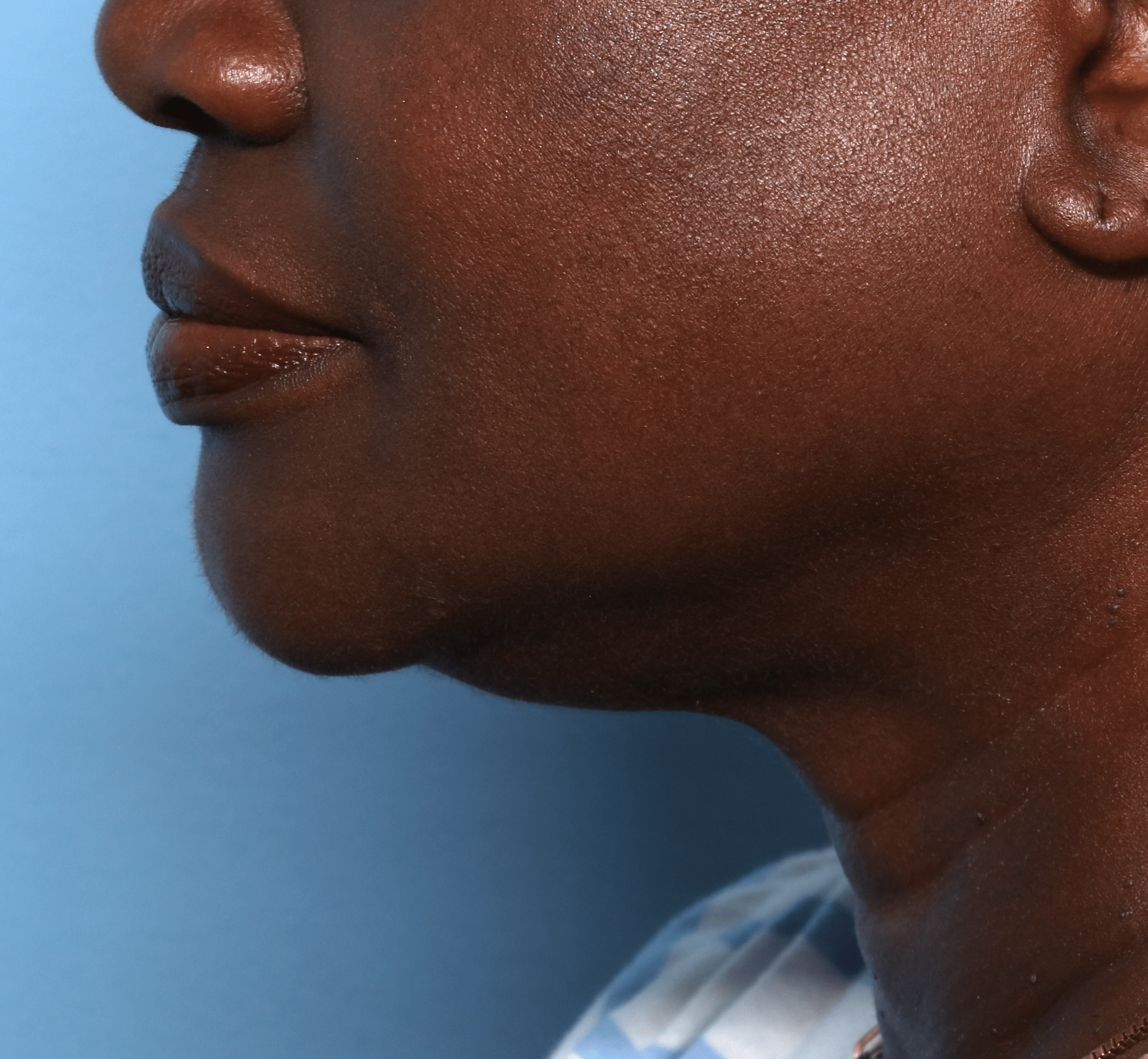 After Image: CoolSculpting – Submentum - left-side