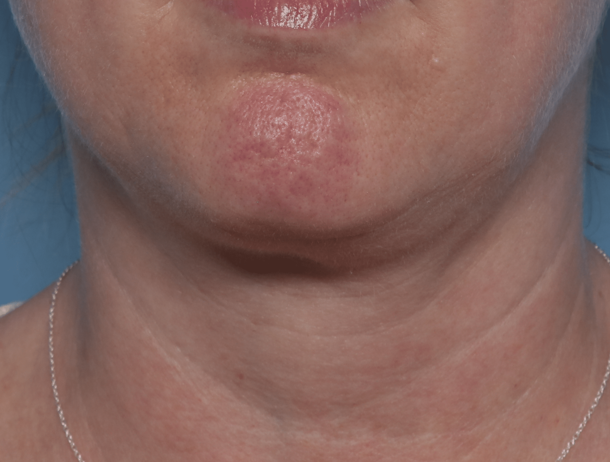 After Image: Kybella – Submentum - front