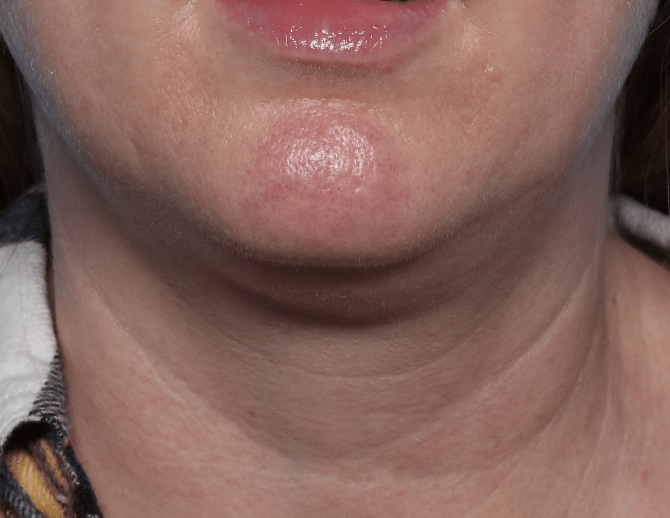 Before Image: Kybella – Submentum - front