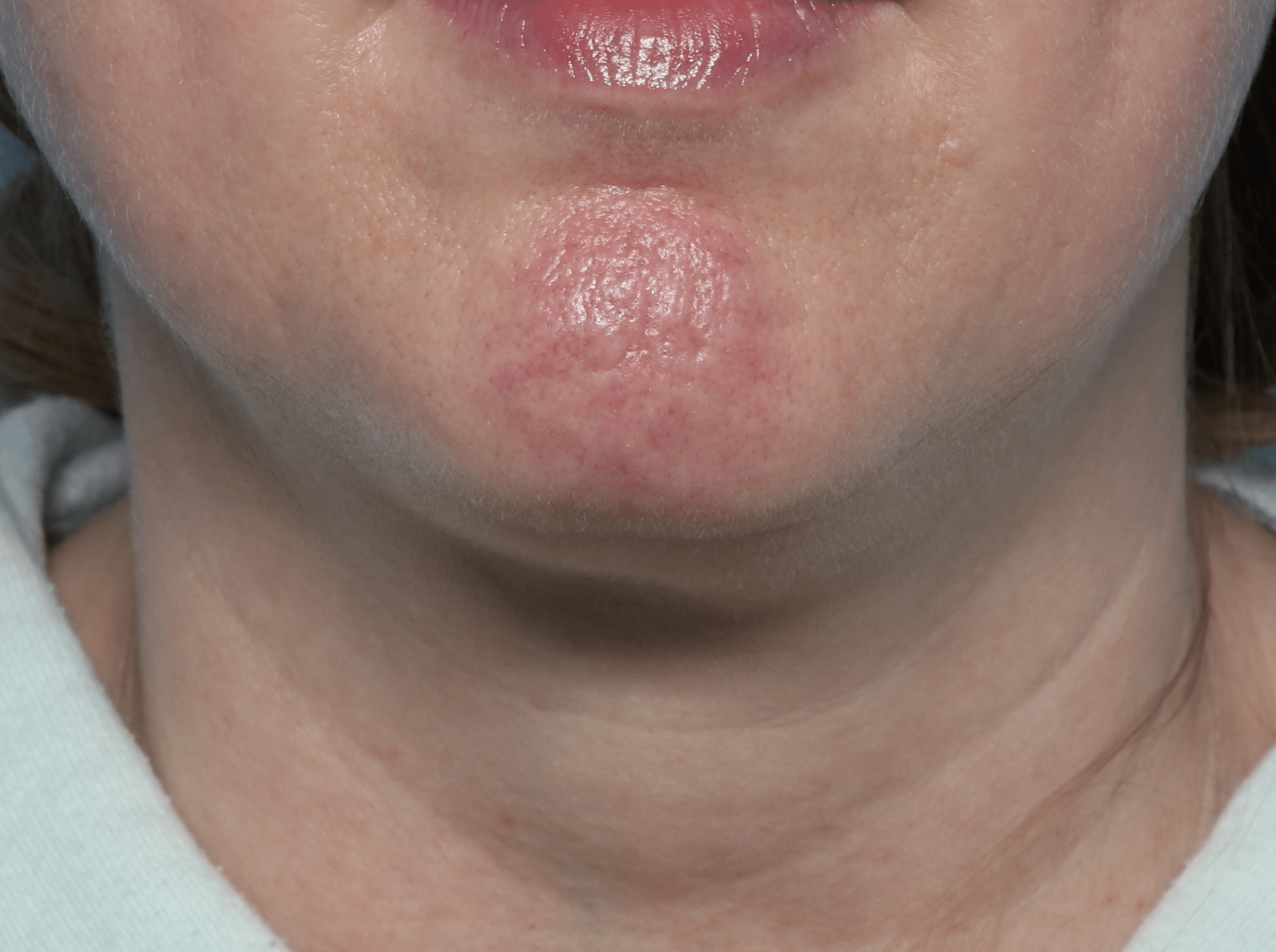 After Image: Kybella – Submentum - front