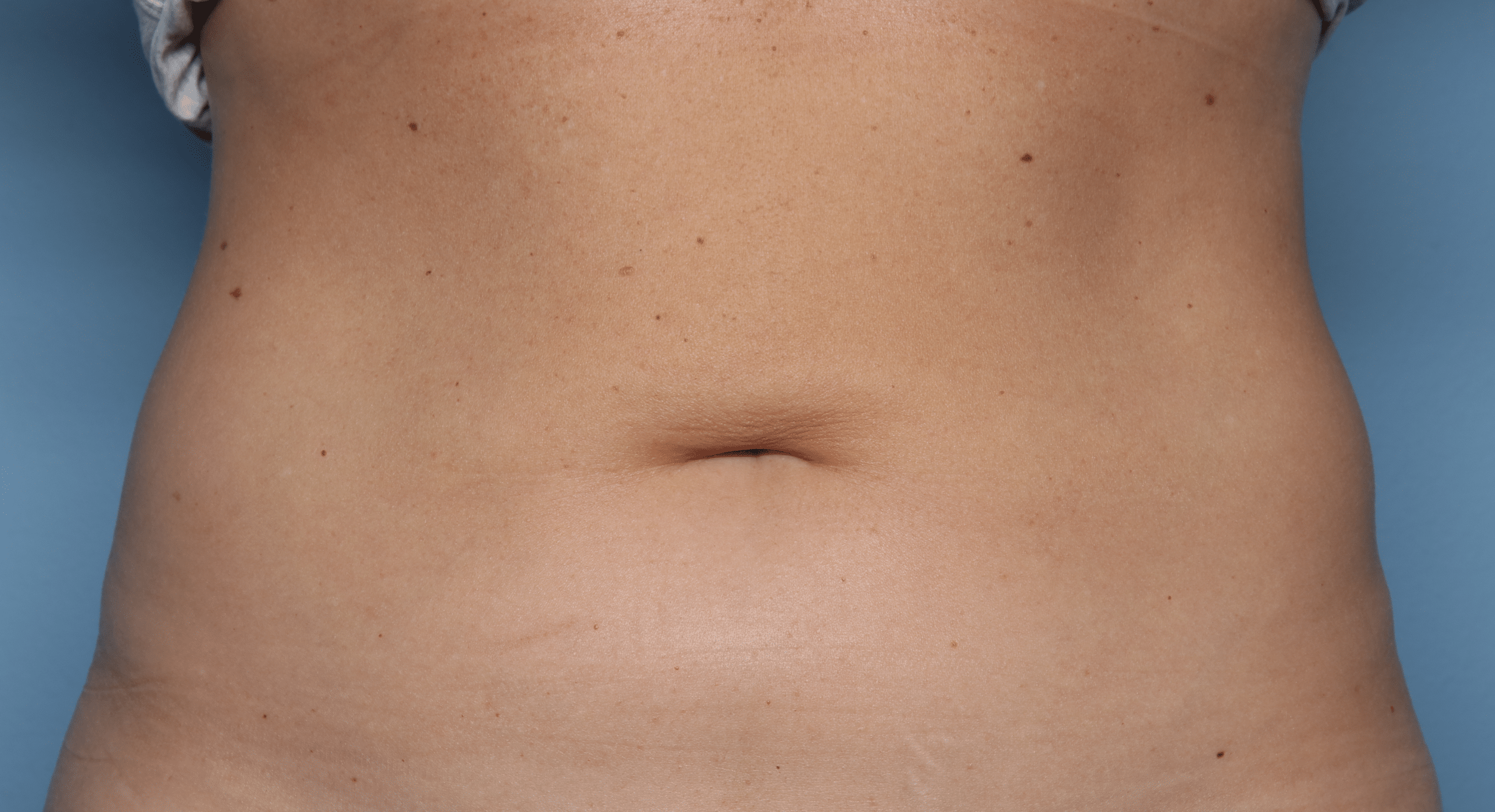 After Image: CoolSculpting – Flanks - front