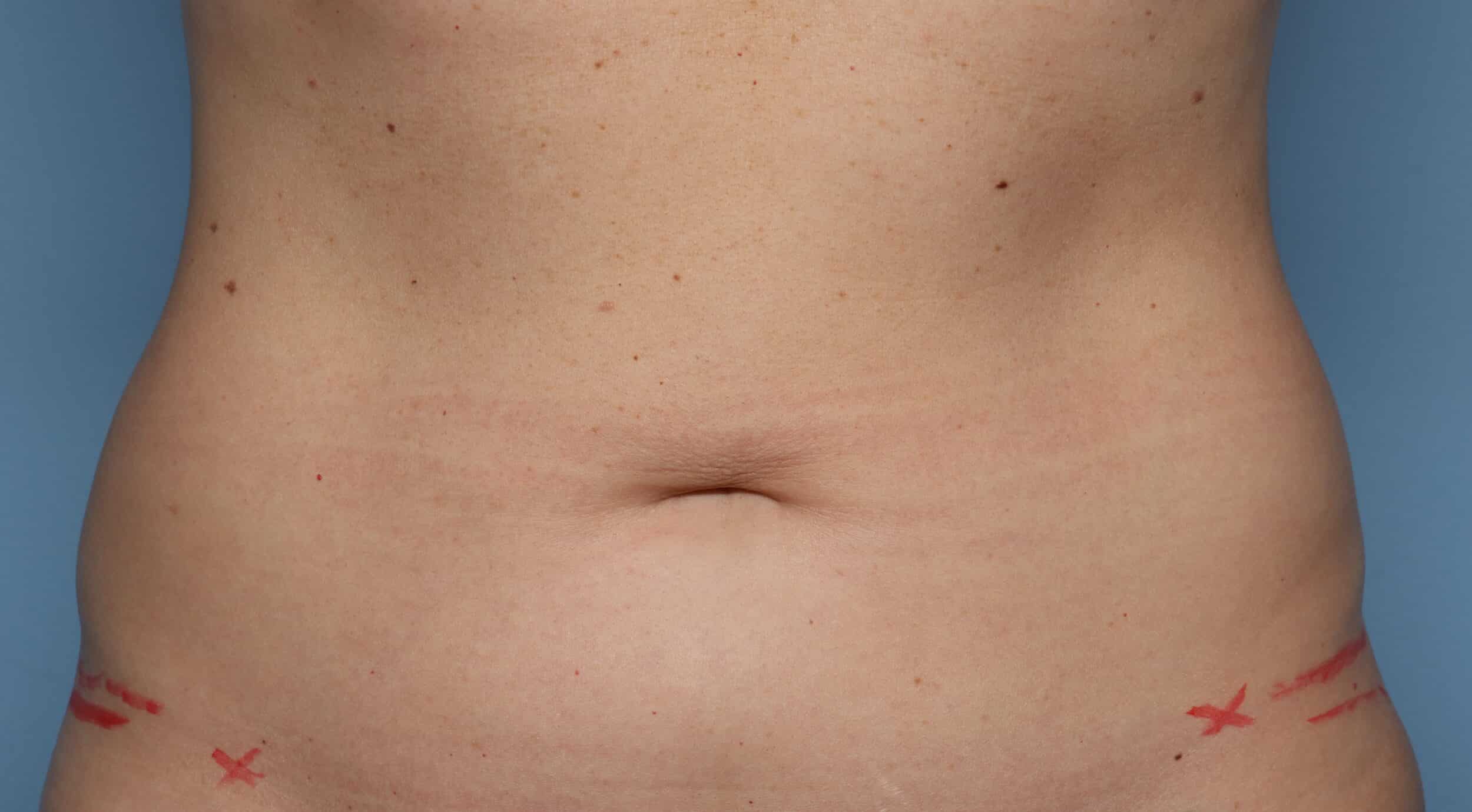 Before Image: CoolSculpting – Flanks - front