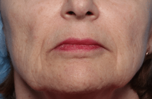 After Image: Thermage