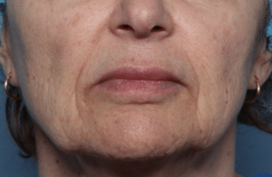 Before Image: Thermage