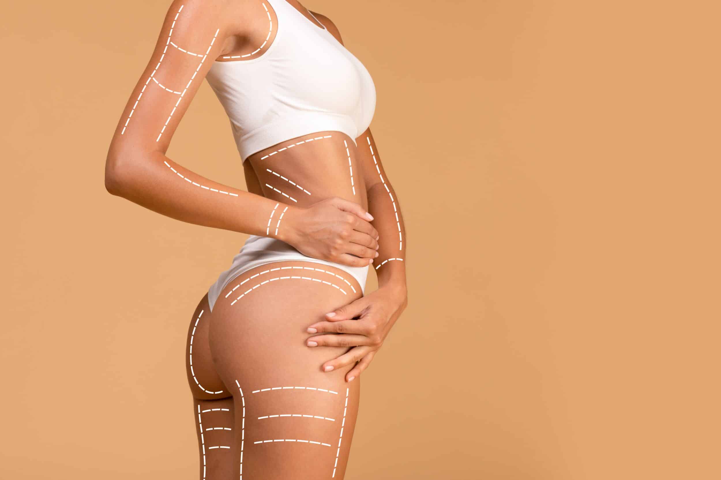 Woman's body with lines indicating areas where Thermage radiofrequency treatment could be used