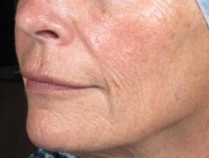 After Image: Brown Spot Treatment