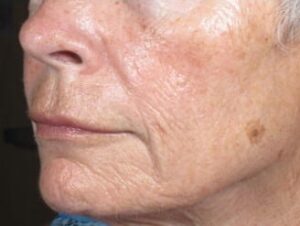 Before Image: Brown Spot Treatment