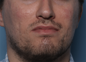After Image: Fractional Laser Treatment