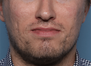 Before Image: Fractional Laser Treatment