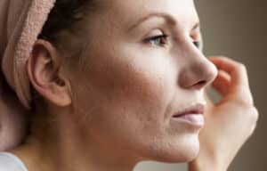 Closeup of woman's face with acne scarring.