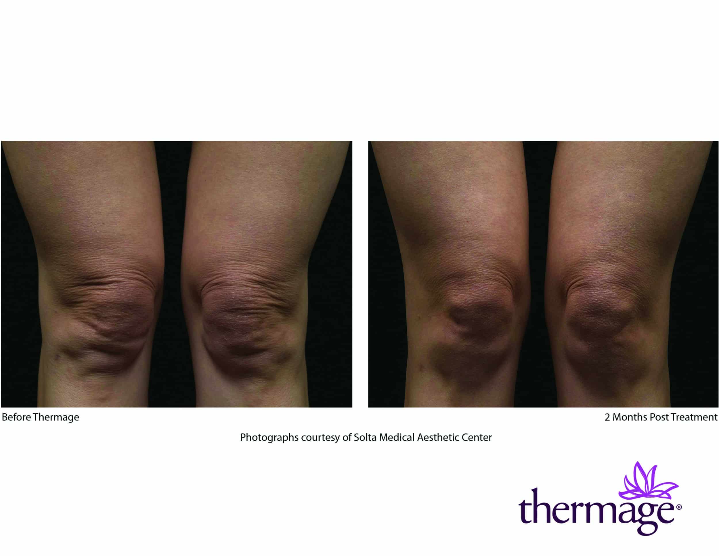 Thermage Before After SMAC 06 Thermage Before After SMAC 06