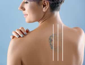 A faded tattoo on a woman's upper back. Three vertical white lines are overlaid on the tattoo area, suggesting laser tattoo removal treatment