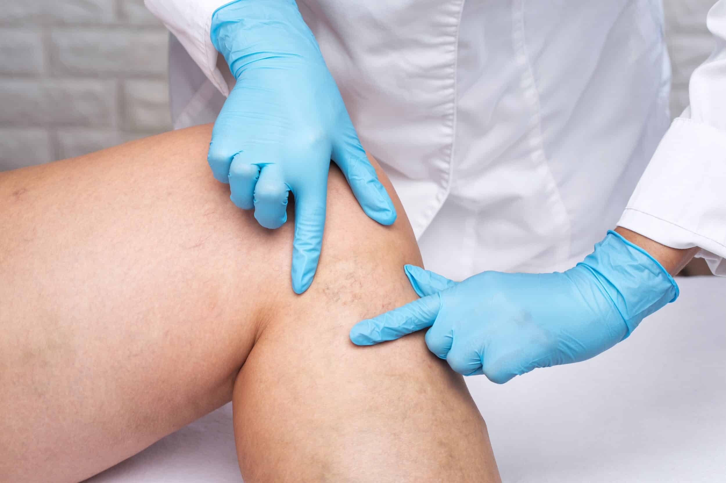 Doctor wearing blue gloves points to visible spider veins on a patient's leg during a sclerotherapy consultation