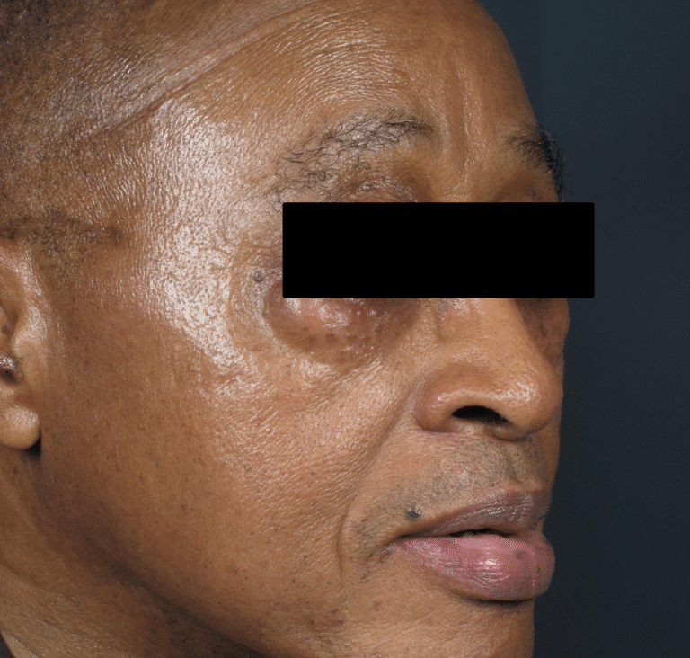 After Image: Iriderm Laser - front