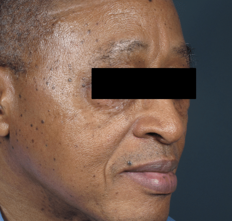 Before Image: Iriderm Laser - front