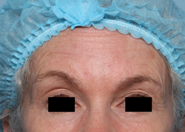After Image: Fractional CO2 - front