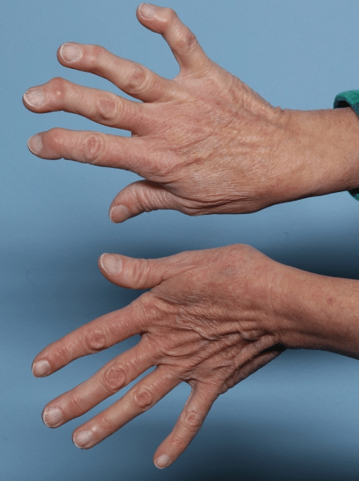 Before Image: Fractional CO2 - other