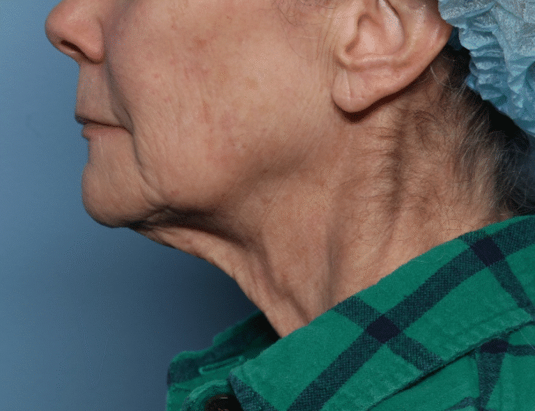 Before Image: Fractional CO2 -