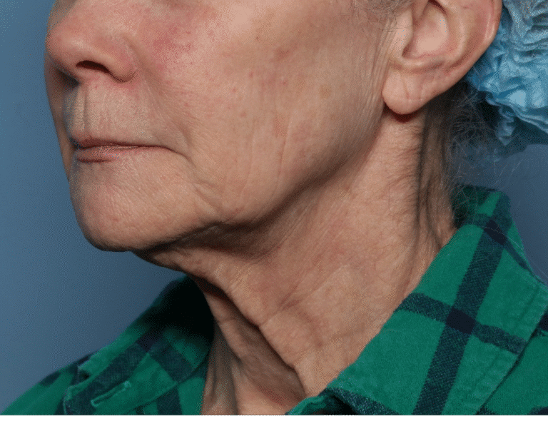 Before Image: Fractional CO2 -